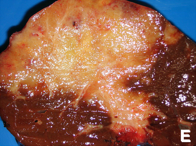 cholangiocarcinoma